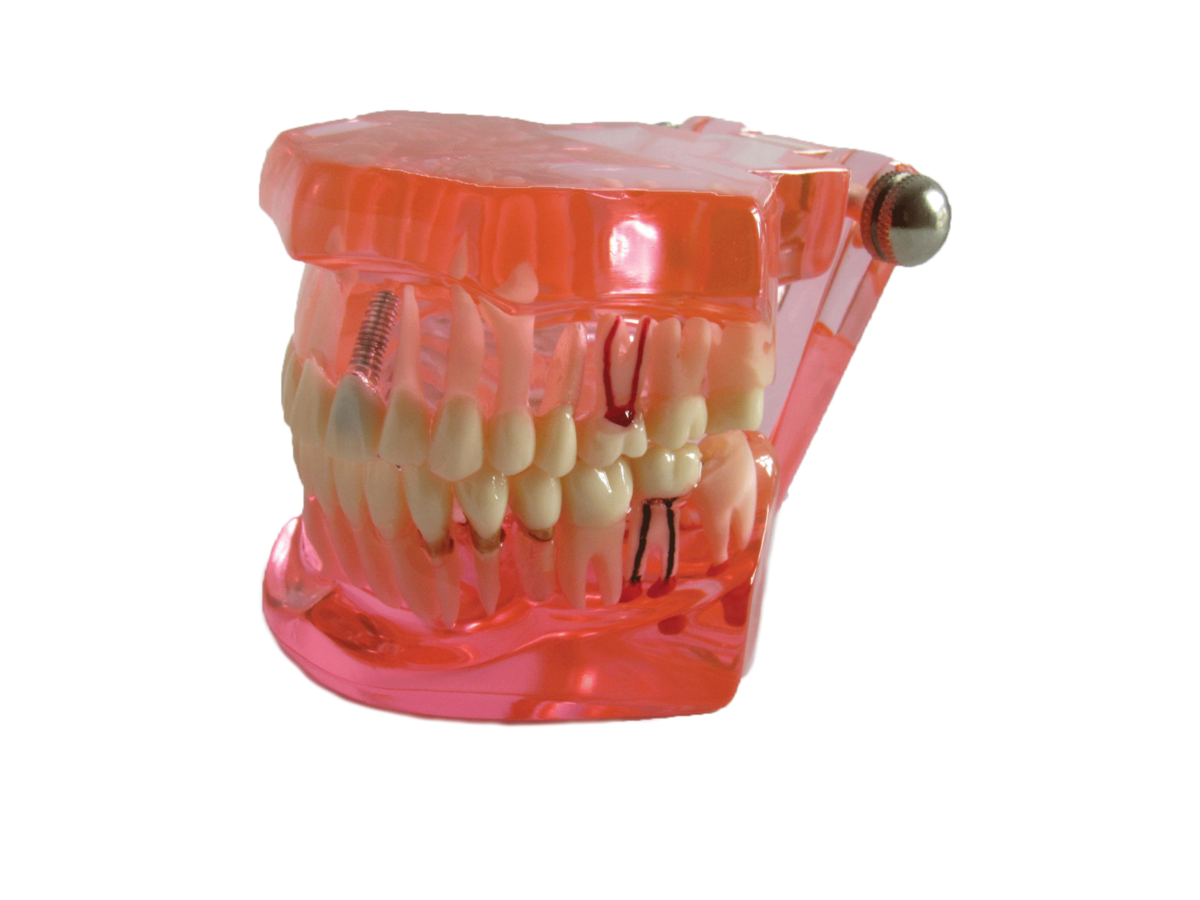 Dental Teaching Model for Patient Education