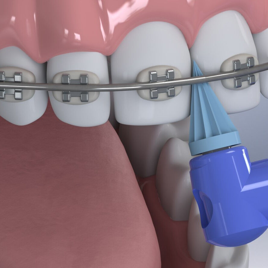 Young Classic Disposable Prophy Angle with Pointed Polisher (Firm)