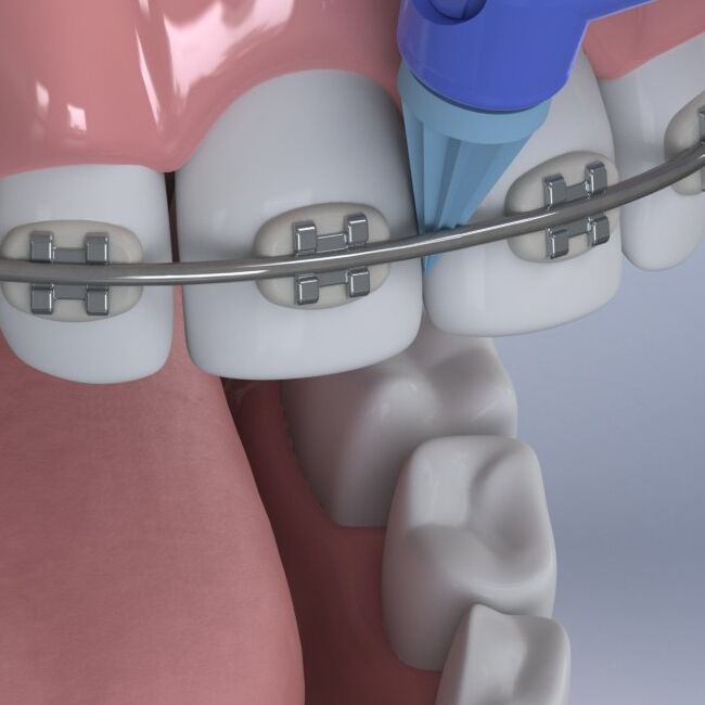 Young Classic Disposable Prophy Angle with Pointed Polisher (Firm)